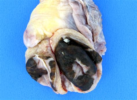 Teratoma in a 49 y/o male | This 49 y/o male presented with … | Flickr