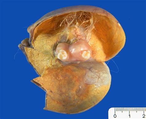 Teratoma maduro benigno del ovario  3    DocCheck