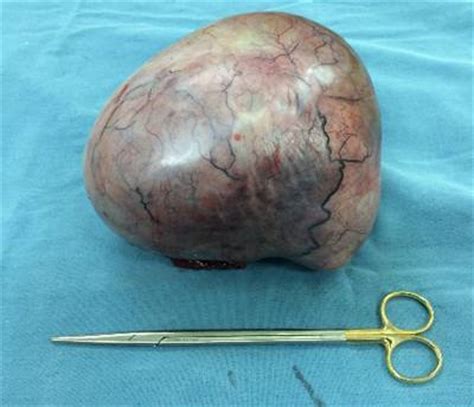 Teratoma maduro ovárico gigante en una paciente adolescente de ...