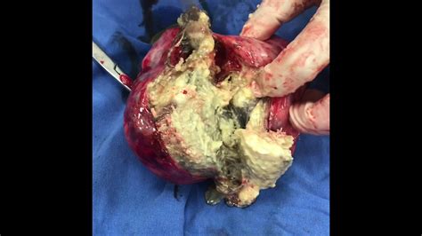 Teratoma Ovarico bilateral   YouTube