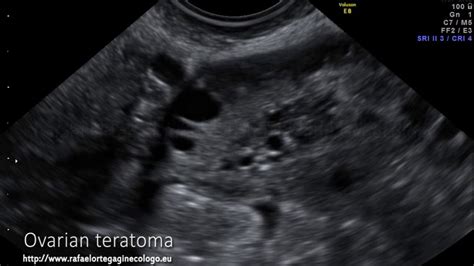 Teratoma ovarico ecografia 2D 3D Dr. Rafael Ortega Muñoz Ginecologo ...