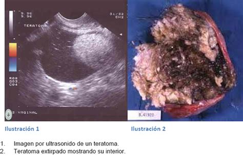 Teratoma Ovarico   EcuRed