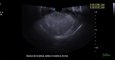 Teratoma Ovarico