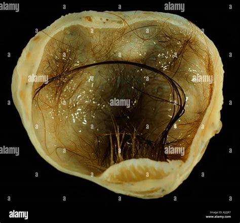 Teratoma quístico maduro de ovario Fotografía de stock   Alamy