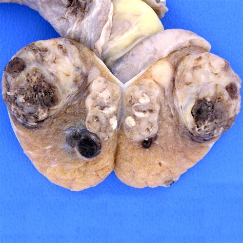 Teratoma testicular   fillkos.web44.net