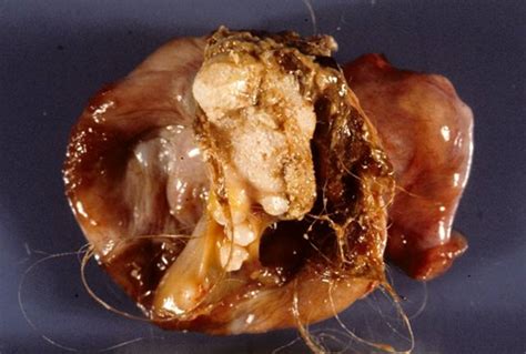 Teratoma tumor containing hair, bone, and teeth   Altered Dimensions ...