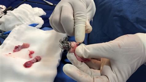 Teratoma  tumor ovárico  cirugía pediátrica   YouTube