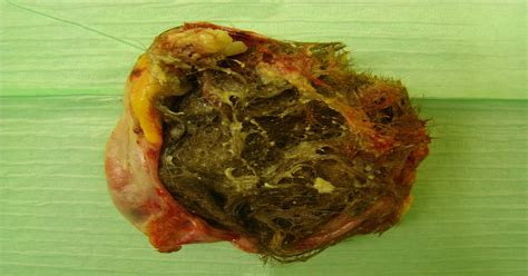 Teratoma, Tumor which can have teeth and hair. : WTF