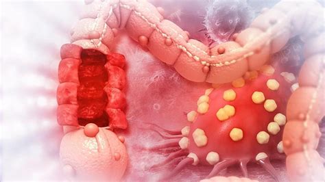Test de sangre podría detectar el cáncer de colon 15 años ...