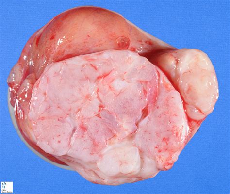 testicular mixed germ cell tumor   Humpath.com   Human pathology