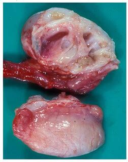Testicular teratoma   gross | pouchofdouglas | Flickr