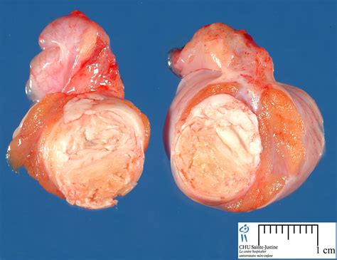 testicular teratoma   Humpath.com   Human pathology