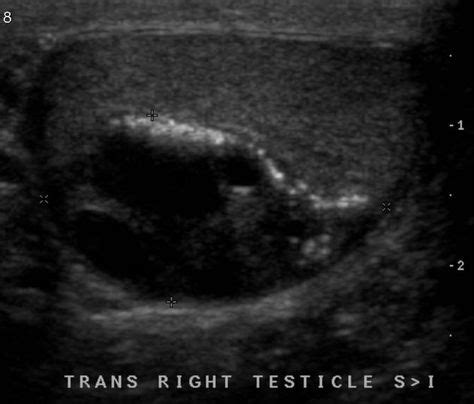 ..Testicular teratoma, unlike ovarian teratoma, is often aggressive in ...