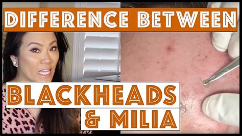 The difference between blackheads and milia with INTRO ...
