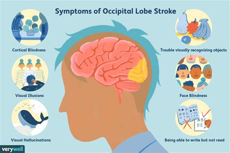 The Effects of an Occipital Lobe Stroke