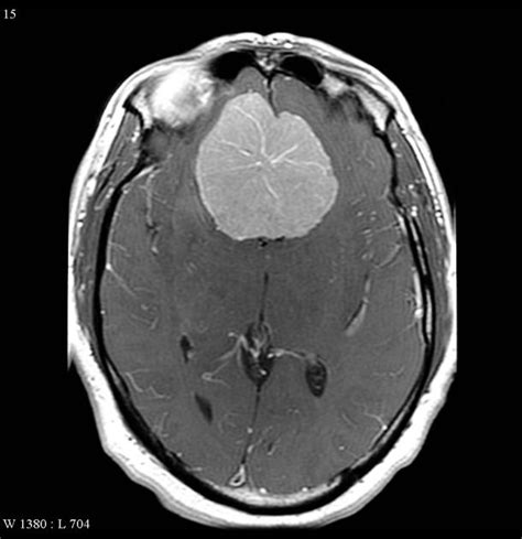 The Neurocritic: Can a Slow Growing Brain Tumor Cause a ...