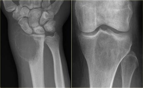 The Radiology Assistant : Bone tumor   ill defined ...