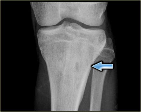 The Radiology Assistant : Bone tumor   ill defined ...