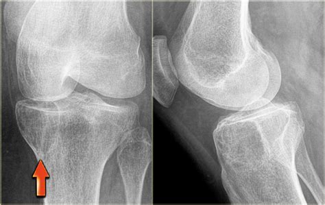 The Radiology Assistant : Bone tumor   well defined ...