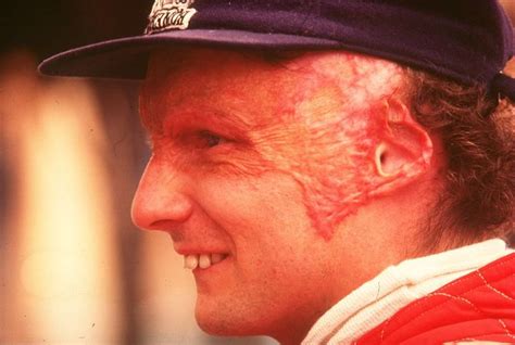 The Scarface hero   40 years from Niki Lauda’s crash   MercedesBlog