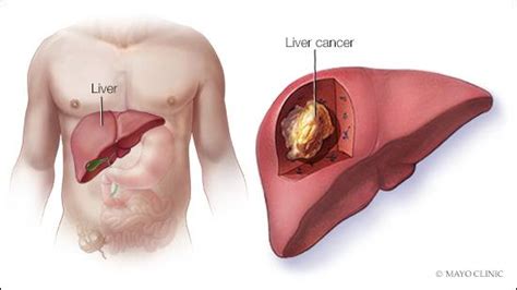 The Scary Truth About Liver Cancer   IDS Medical Systems ...