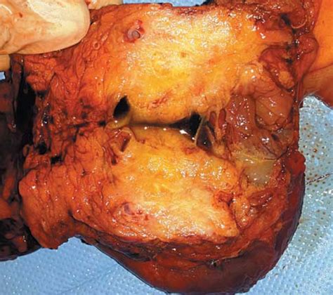 The specimen: pancreatic head tumor en bloc with the ...