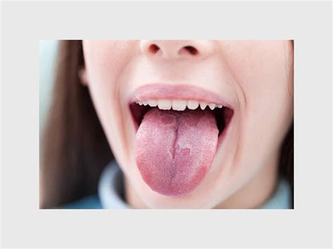 The warning signs of tongue cancer   Randfontein Herald