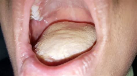 thick white tongue very severe oral thrush oral candidiasis in young ...