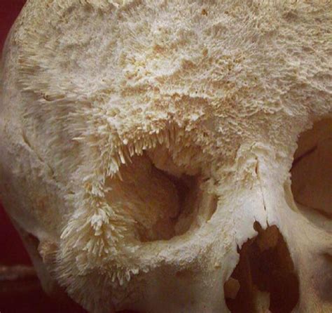 This is what bone cancer looks like : pics