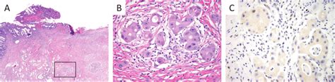 This neoadjuvantly treated rectal adenocarcinoma consists ...
