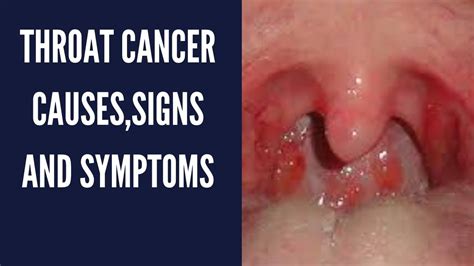 Throat Cancer, Overview,Symptoms,Causes,Risks,Factors ...