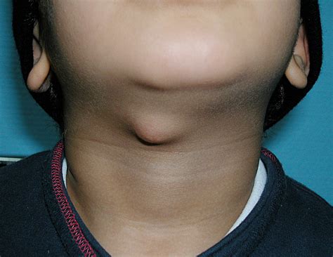 Thyroglossal Duct Cyst   Pictures, Symptoms, Treatment and Surgery