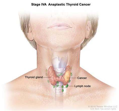 Thyroid Cancer Treatment  Adult   PDQ –Health ...