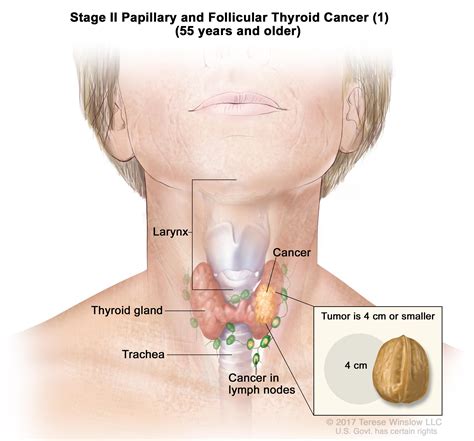 Thyroid Cancer Treatment  Adult   PDQ –Patient Version ...