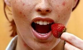 Tipos de alergias más comunes de los alimentos   Personas Que