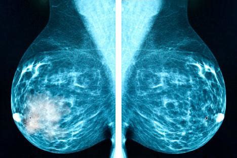 Tipos de cáncer de mama: no invasores, carcinoma ...