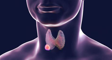 Tipos de cáncer de tiroides: papilar, folicular, anaplásico…