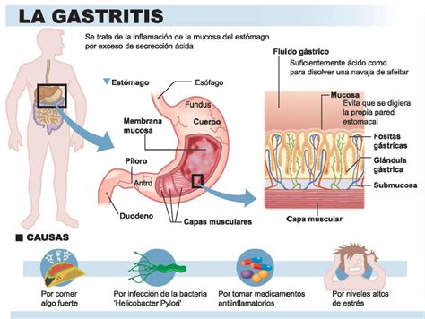 Tipos de Gastritis