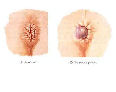 Tipos de hemorroides: internas, externas y su ...