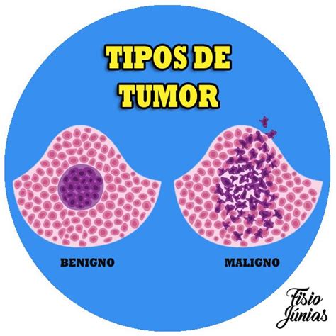 Tipos de tumor | Fisio, Câncer