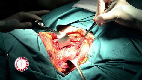 Tiroidectomía por Carcinoma Papilar de Tiroides   YouTube