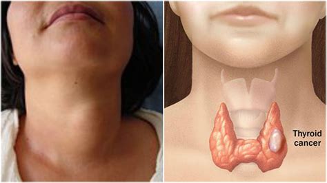 Tiroides: diversas afecciones de la glándula endocrina