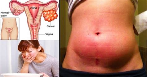 [Todays Viral] 10 deadly symptoms of Ovarian Cancer that ...
