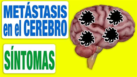 Todos los Síntomas de las Metástasis en el Cerebro   YouTube