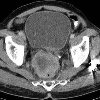 Tomografia computadorizada mostrando tumor de próstata ...