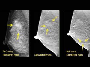 Tomosíntesis para el diagnóstico precoz del cáncer de mama