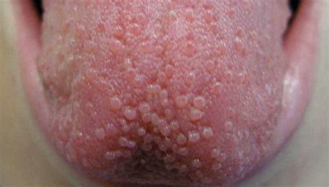 Tongue bumps: Causes, when to see a doctor, and treatment