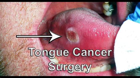 Tongue Cancer | Early stage cancer detection cure by minor ...