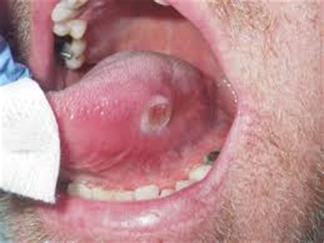 Tongue Cancer | India| PDF | PPT| Case Reports | Symptoms ...