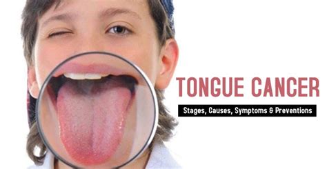 Tongue Cancer  Stages, Causes, Symptoms & Preventions